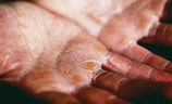 湿疹治疗方式大揭秘：手上湿疹若何治疗？